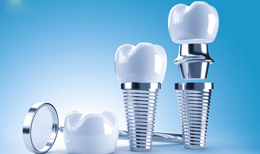 Giá cả làm răng Implant ở đâu tốt? Chất lượng bảo đảm?