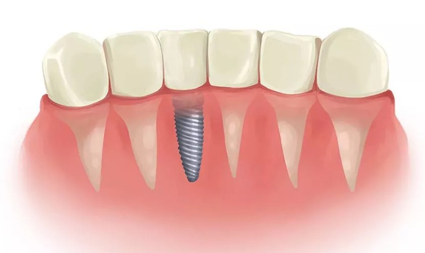 Làm răng Implant là phương pháp được nhiều người lựa chọn