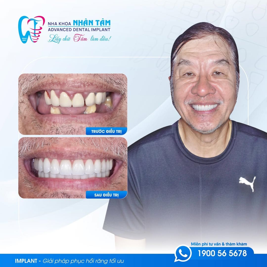 giá cấy ghép răng implant tại việt nam