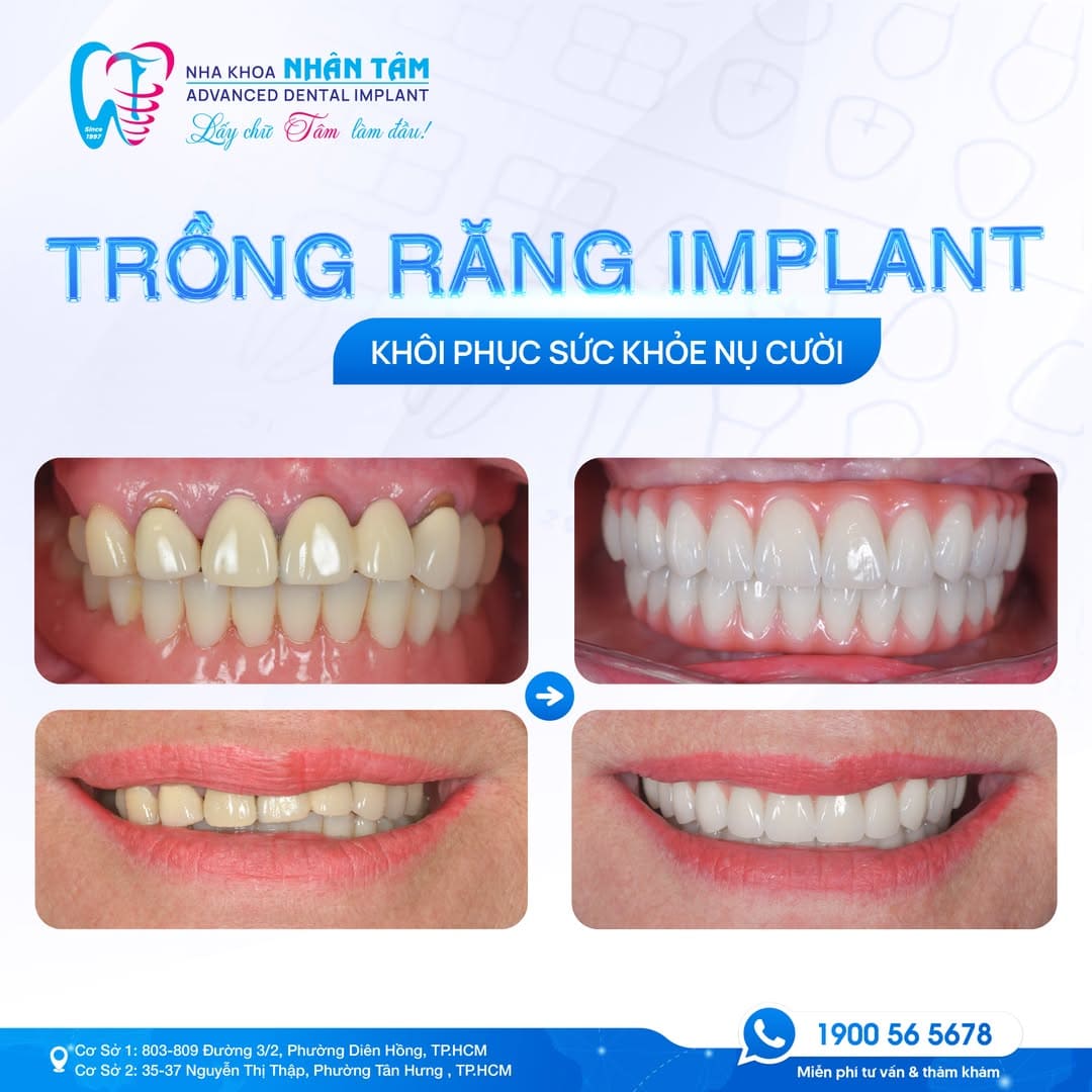 giá implant 1 trụ là bao nhiêu