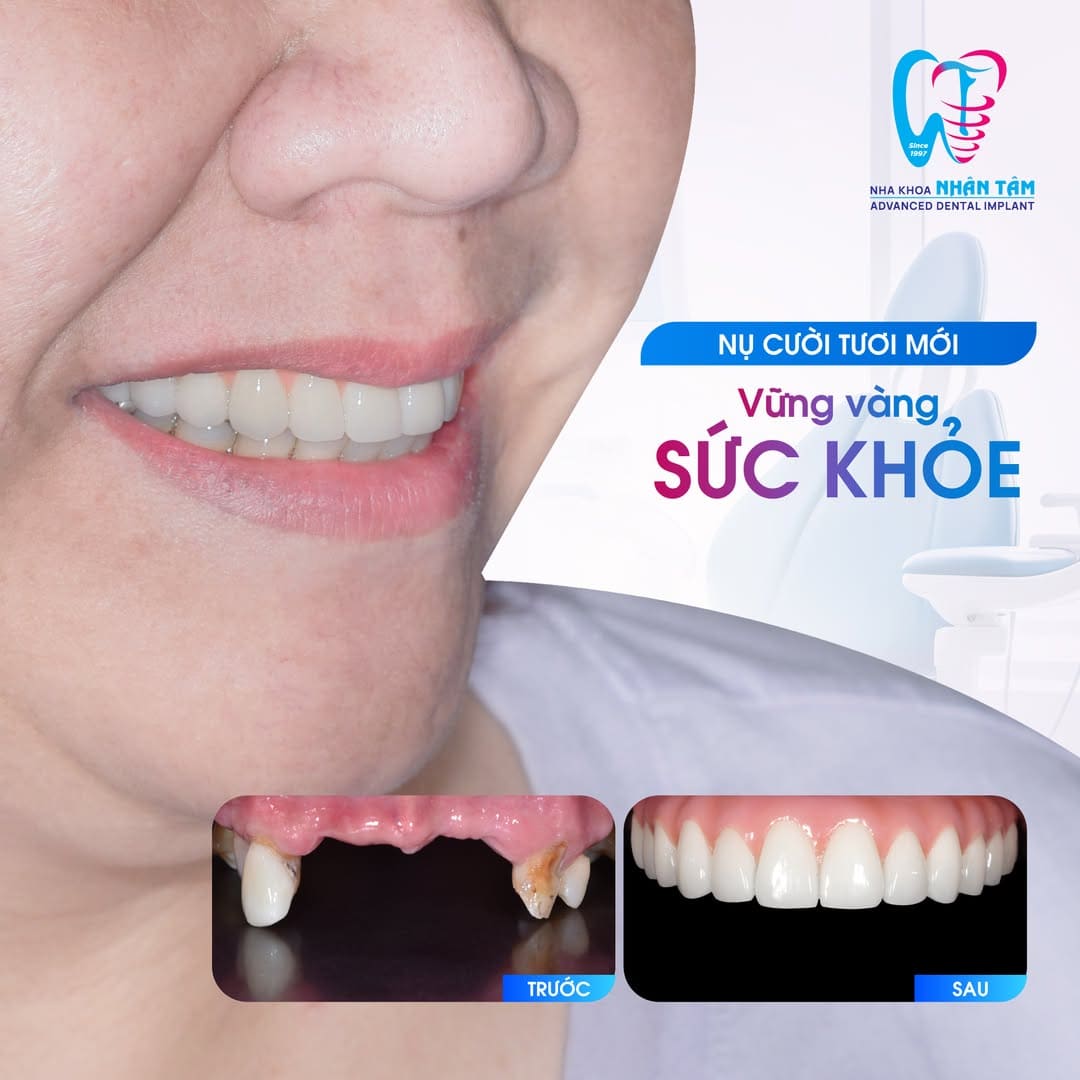 giá implant all on 6