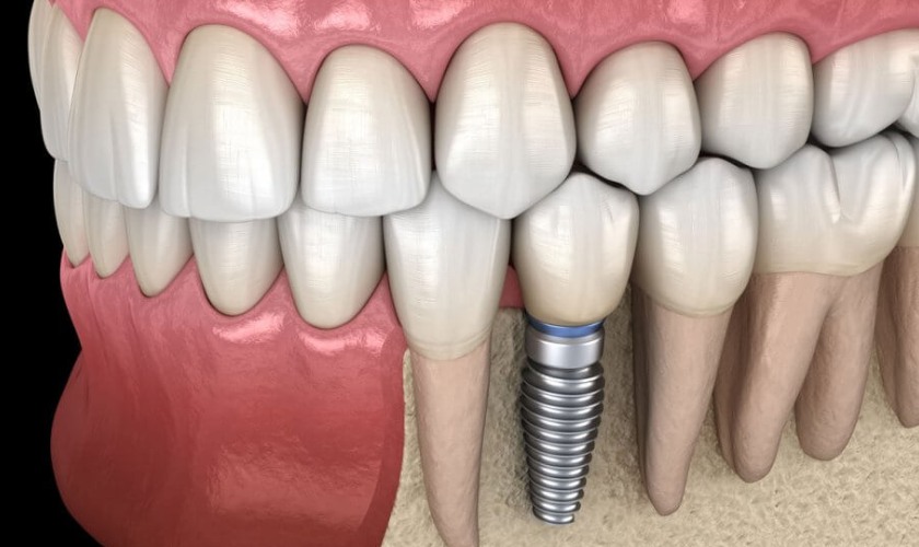 Giá trồng răng Implant Tekka Pháp và Zygomatic bao nhiêu?
