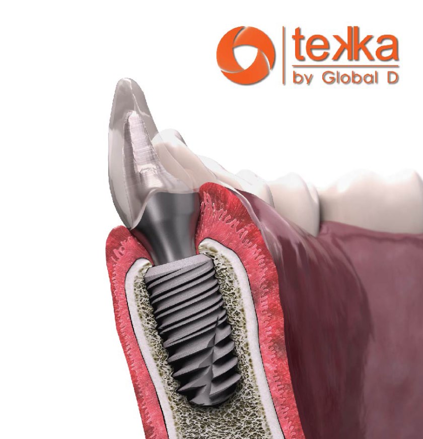 Trụ Implant Tekka Pháp