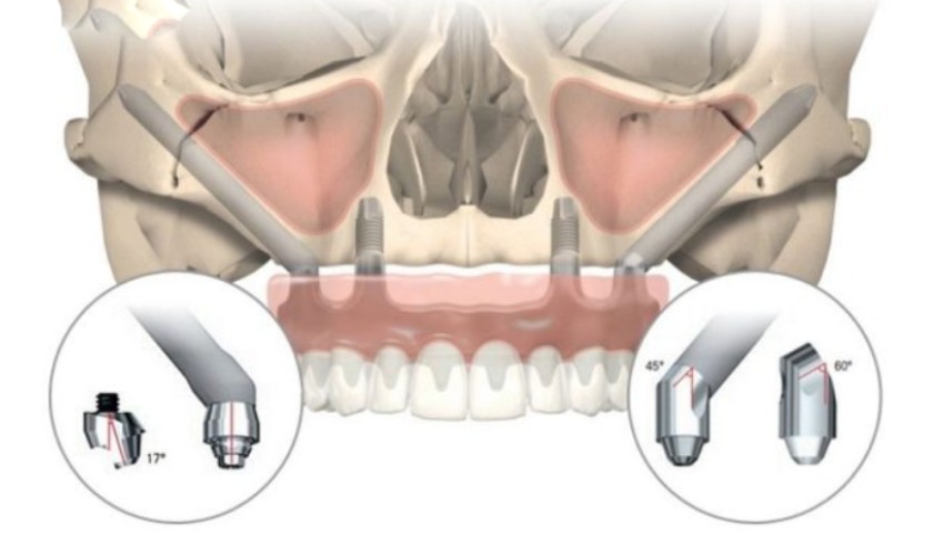 Implant Zygomatic (Implant xương gò má)