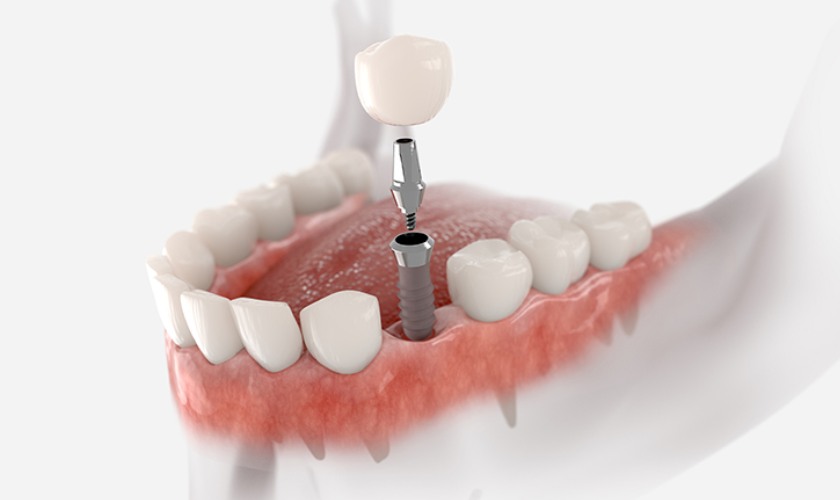 Giá trồng răng Implant sẽ khác nhau ở mỗi người