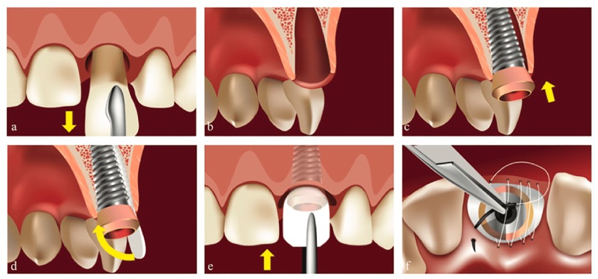 Trồng răng Implant tức thì là phương pháp nhổ răng và cấy Implant cùng một lúc Trồng răng Implant tức thì là phương pháp nhổ răng và cấy Implant cùng một lúc