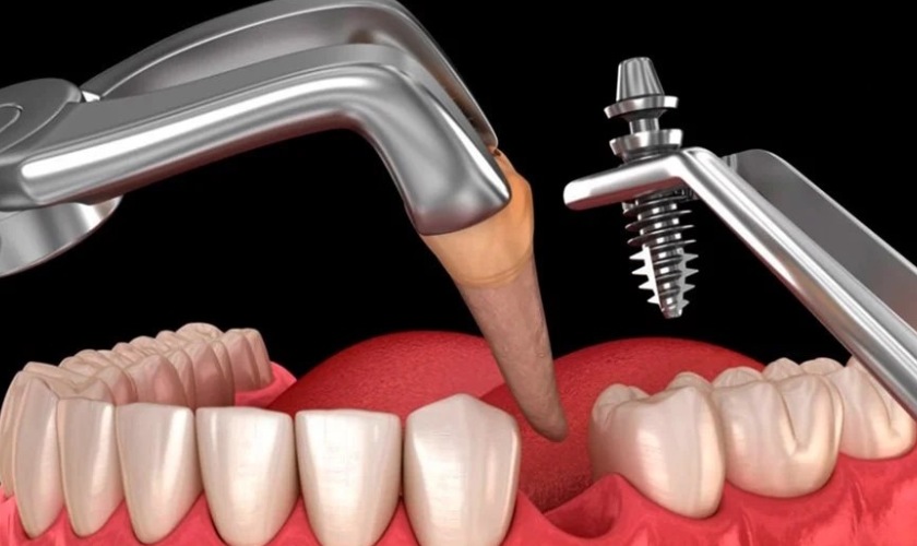 Implant tức thì mang đến nhiều ưu điểm vượt trội Implant tức thì mang đến nhiều ưu điểm vượt trội
