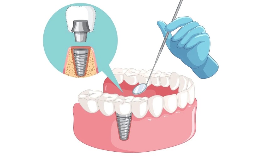 Giá Implant tức thì phụ thuộc vào nhiều yếu tố Giá Implant tức thì phụ thuộc vào nhiều yếu tố