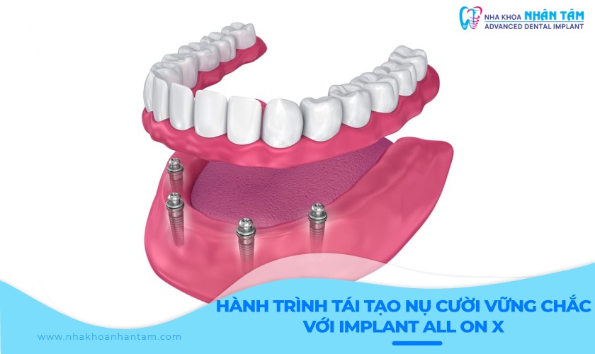 Hành trình tái tạo nụ cười vững chắc với Implant All on X