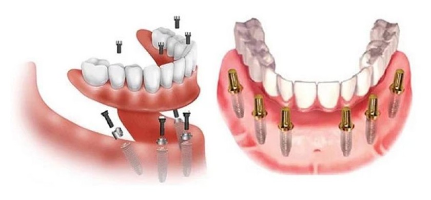 Kỹ thuật Implant All on X Kỹ thuật Implant All on X