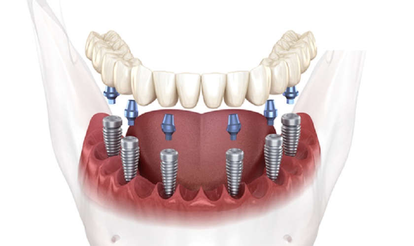 Implant All on X mang đến nhiều lợi ích vượt trội Implant All on X mang đến nhiều lợi ích vượt trội