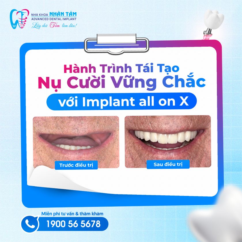 Hành trình tái sinh nụ cười của chú Karl Pany Hành trình tái sinh nụ cười của chú Karl Pany