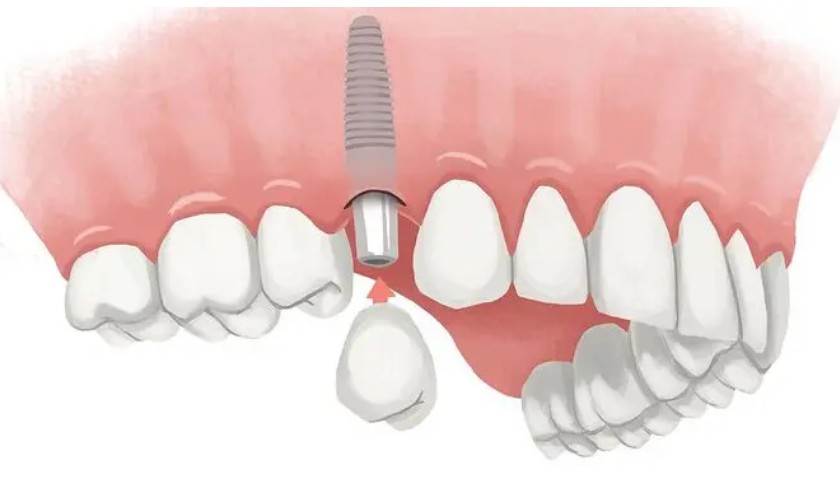 Cấy ghép Implant là công nghệ hiện đại phục hình răng hiệu quả