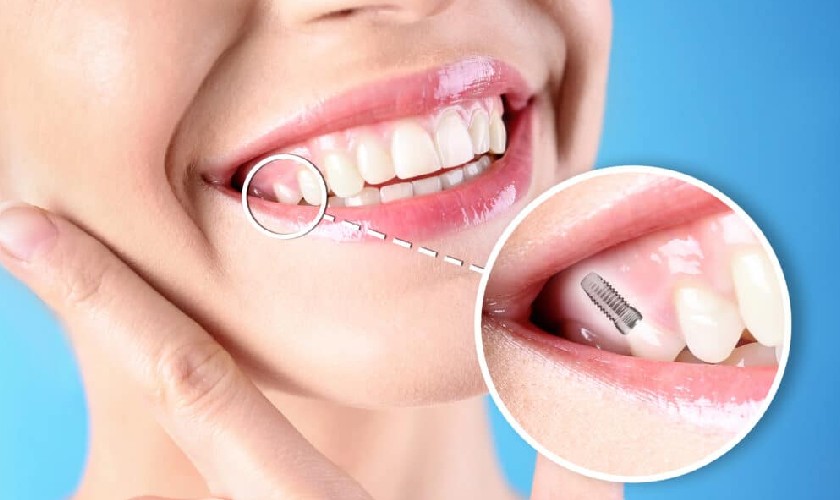 Trồng răng Implant là phương pháp phục hình răng được các chuyên gia đánh giá cao