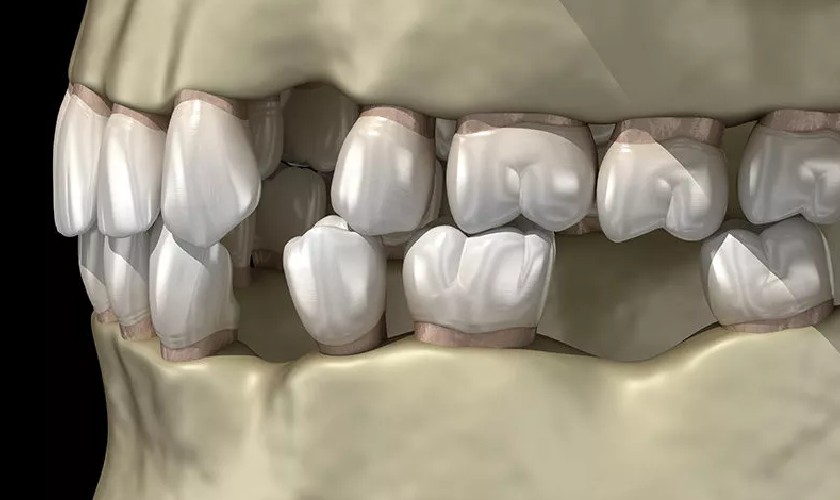 Xương hàm bị tiêu do mất răng