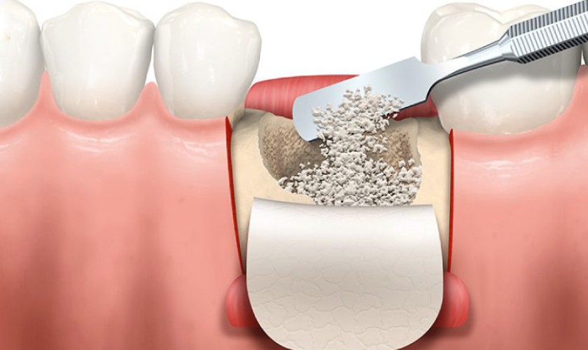 Ghép xương trong trường hợp tiêu xương hàm