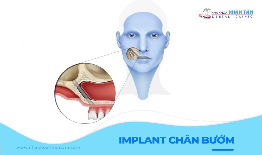 Implant chân bướm và những điều cần biết
