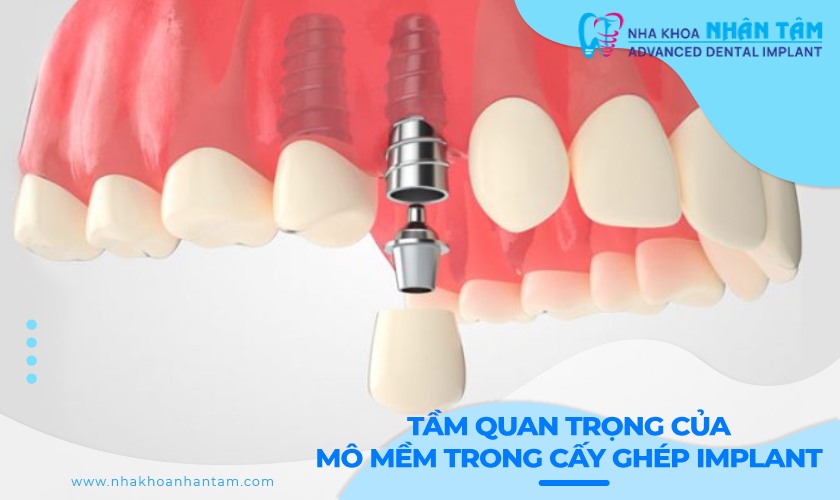 Tầm quan trọng của mô mềm trong cấy ghép Implant