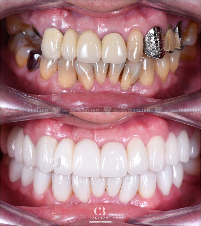 Mô mềm trong cấy ghép Implant đóng vai trò vô cùng quan trọng