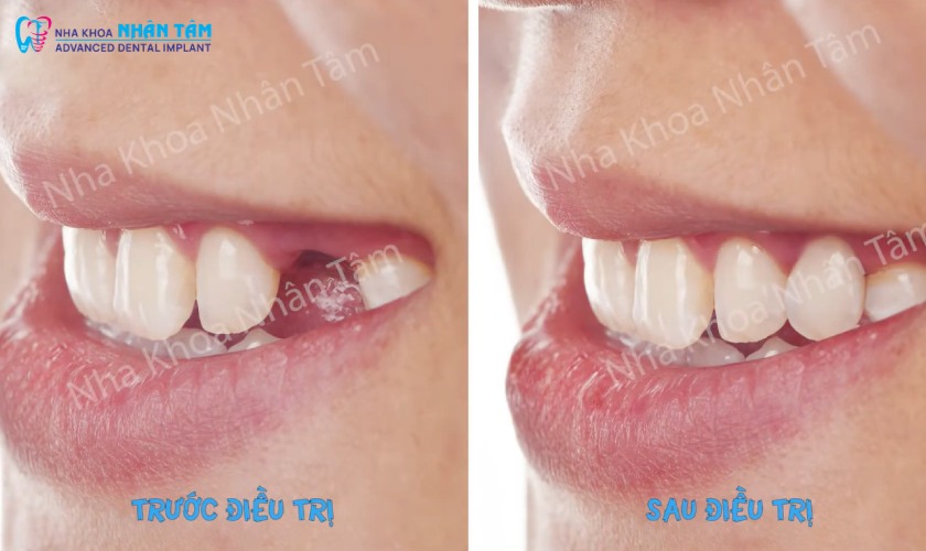 Việc duy trì mô mềm khỏe mạnh là điều kiện tiên quyết để bảo vệ Implant khỏi các biến chứng về sau