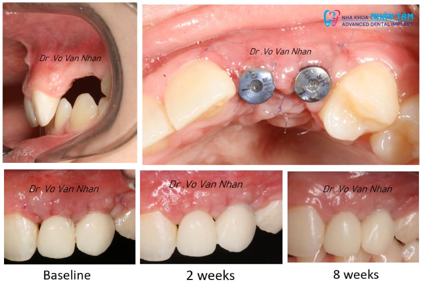 Phục hình hướng dẫn mô mềm (răng hướng dẫn định hình mô nướu quanh răng Implant)