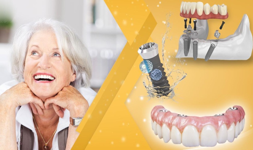 Có nên phục hồi răng toàn hàm bằng Implant khi mất răng?