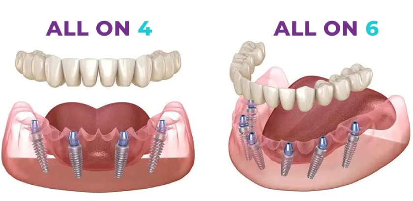 Kỹ thuật trồng răng Implant All on 4, Implant All on 6