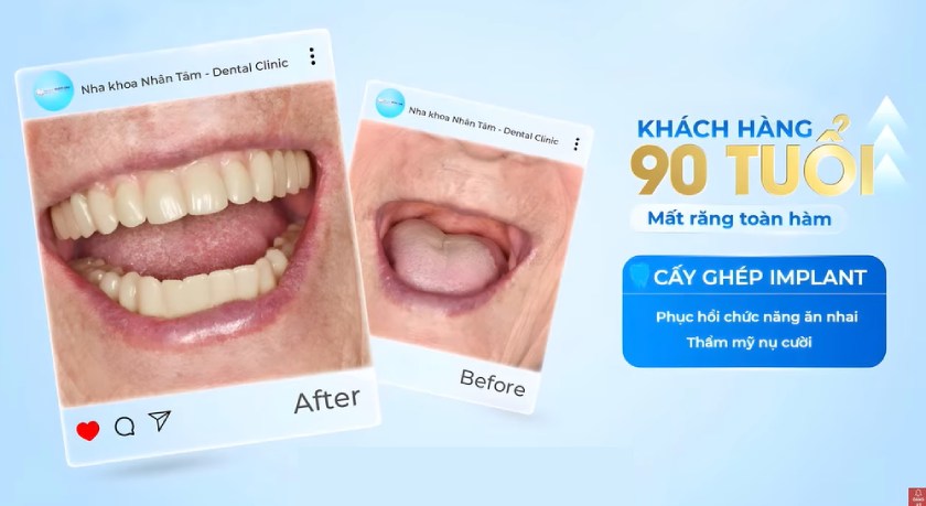 Khách hàng Nguyễn Thị Ngoan cấy ghép Implant tại Nha khoa Nhân Tâm