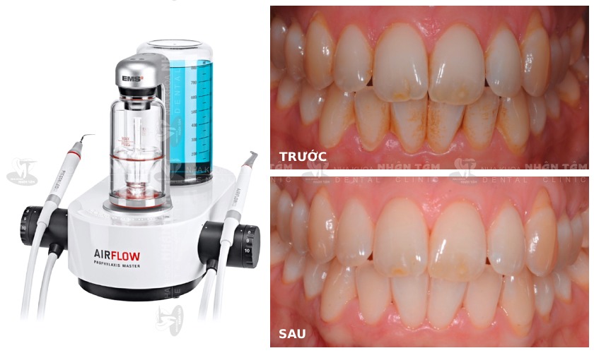 Công nghệ Airflow Prophylaxis giúp loại bỏ hoàn toàn mảng bám và vi khuẩn