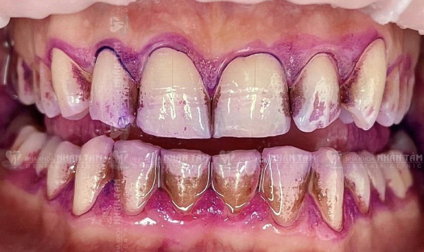 Mảng bám được bộc lộ rõ