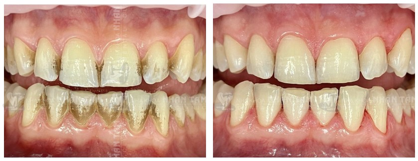 Mảng bám vôi răng đã được làm sạch hoàn toàn