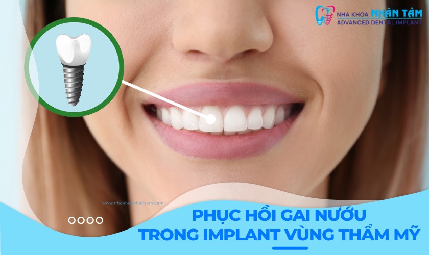 Phục hồi gai nướu trong Implant vùng thẩm mỹ