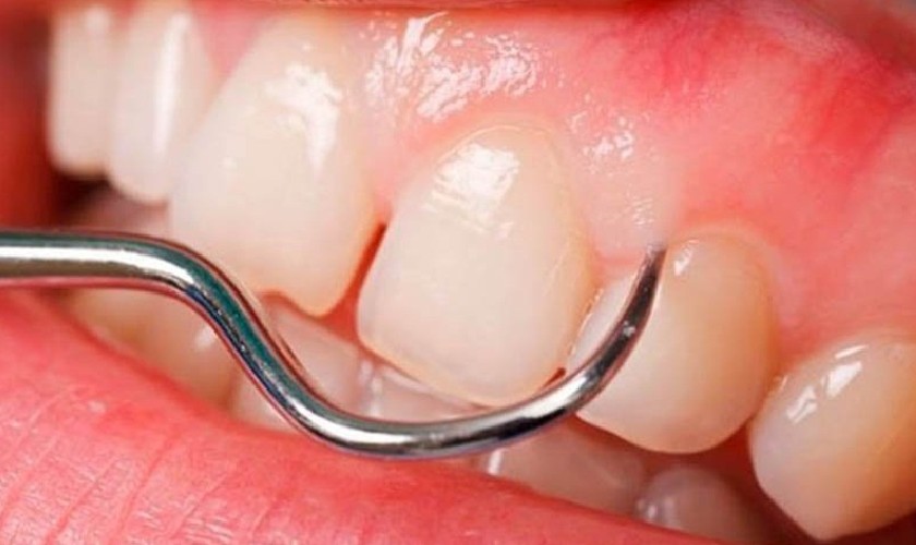 Gai nướu là phần mô nướu nhỏ hình tam giác nằm giữa hai răng Gai nướu là phần mô nướu nhỏ hình tam giác nằm giữa hai răng