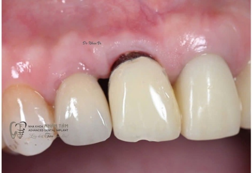 Implant vùng thẩm mỹ là một thách thức lớn để duy trì được gai nướu theo thời gian Implant vùng thẩm mỹ là một thách thức lớn để duy trì được gai nướu theo thời gian