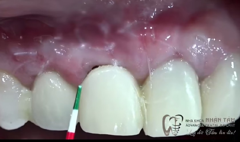 Giải pháp phục hồi gai nướu tại Nha khoa Nhân Tâm Giải pháp phục hồi gai nướu tại Nha khoa Nhân Tâm