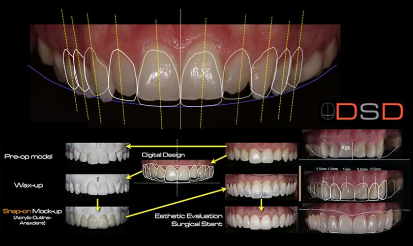Công nghệ Smile Design 2D mô phỏng nụ cười của khách hàng sau khi điều trị bằng hình ảnh 2D