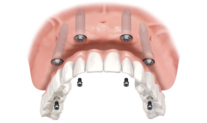 Trồng răng Implant All on 4