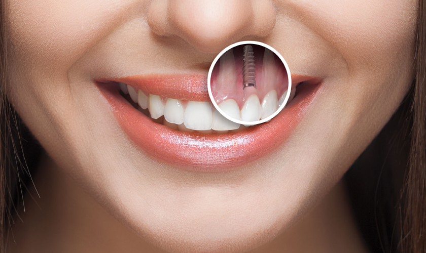 Giá trồng răng sẽ phụ thuộc vào loại trụ implant cũng như loại thân răng sứ mà bệnh nhân chọn