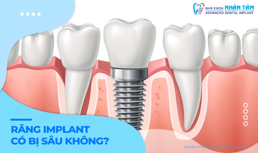 Răng Implant có bị sâu không? Hiểu đúng để phòng ngừa