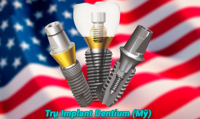 Công nghệ trồng răng Implant Mỹ