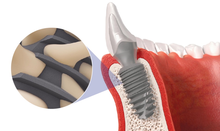 Công nghệ trồng răng Implant Pháp