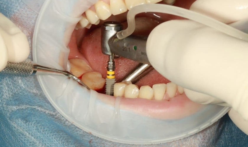 Trồng răng Implant được nhiều người lựa chọn để phục hình răng