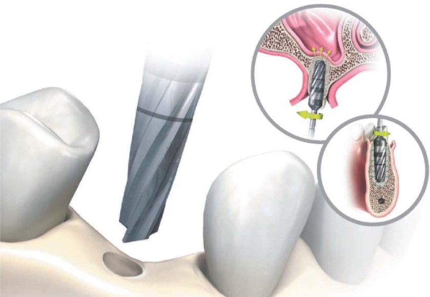 Tích hợp xương là yếu tố quyết định ca cấy ghép Implant có thành công hay không Tích hợp xương là yếu tố quyết định ca cấy ghép Implant có thành công hay không
