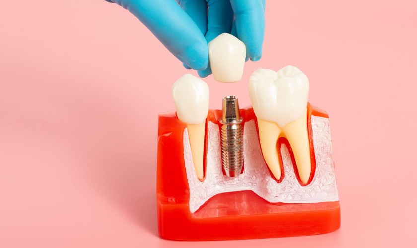 Thời gian sử dụng hay tuổi thọ răng Implant khá dài