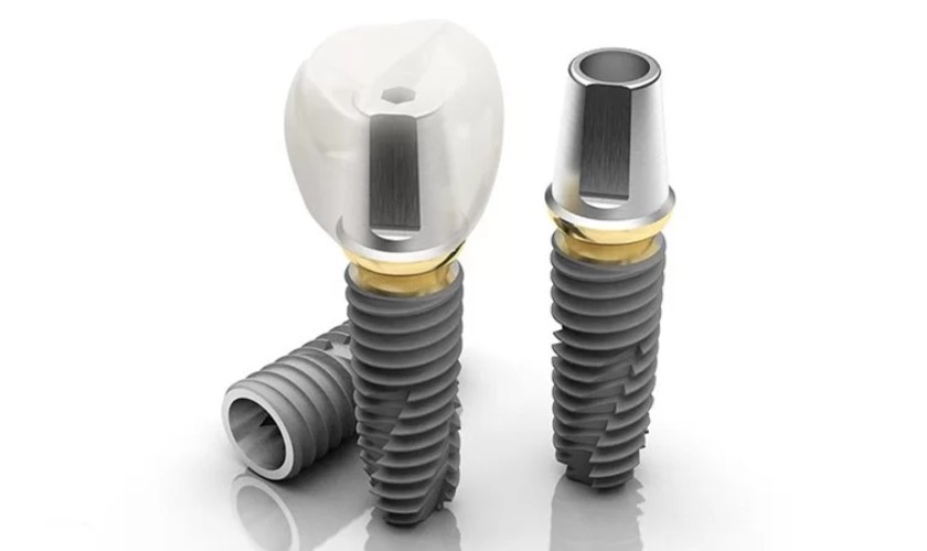Các loại trụ implant khác nhau thì có mức giá khác nhau