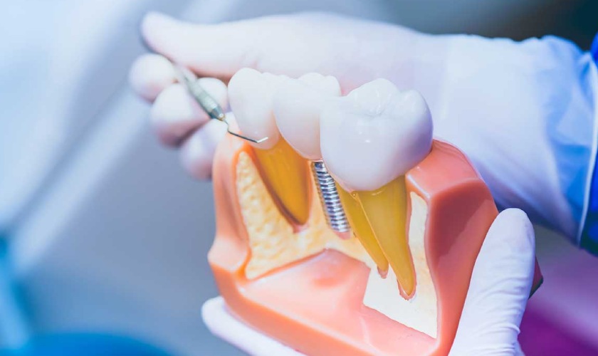 Mức giá Implant nha khoa Nhân Tâm phù hợp với nhiều người Mức giá Implant nha khoa Nhân Tâm phù hợp với nhiều người