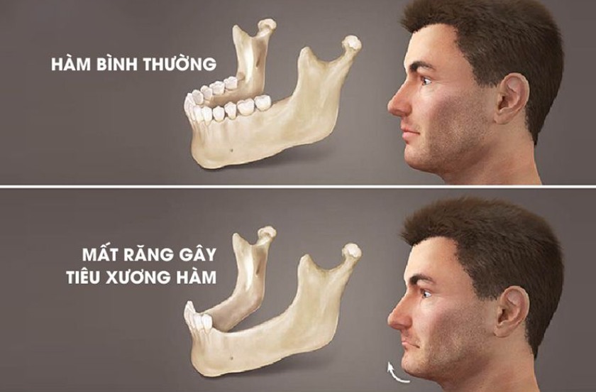 Xương hàm bị tiêu biến sau khi mất răng