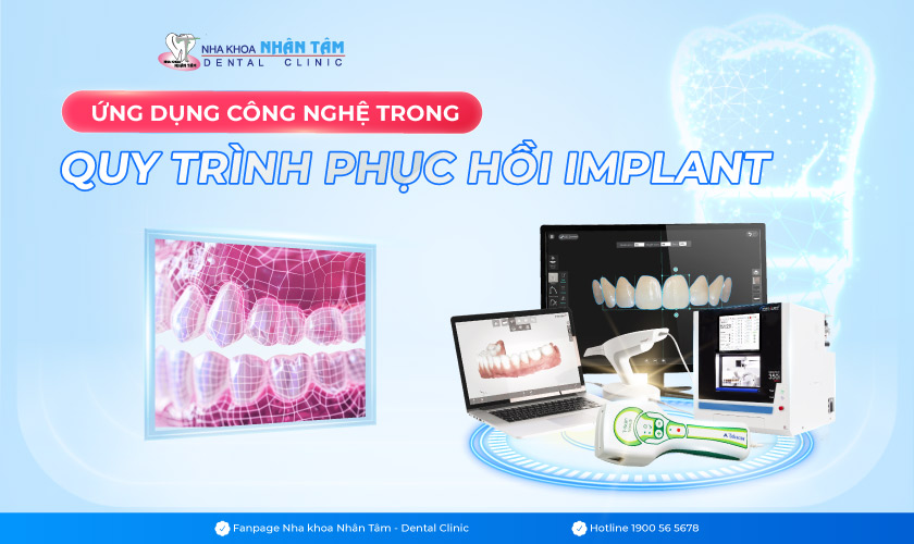 Ứng dụng công nghệ trong quy trình phục hồi Implant