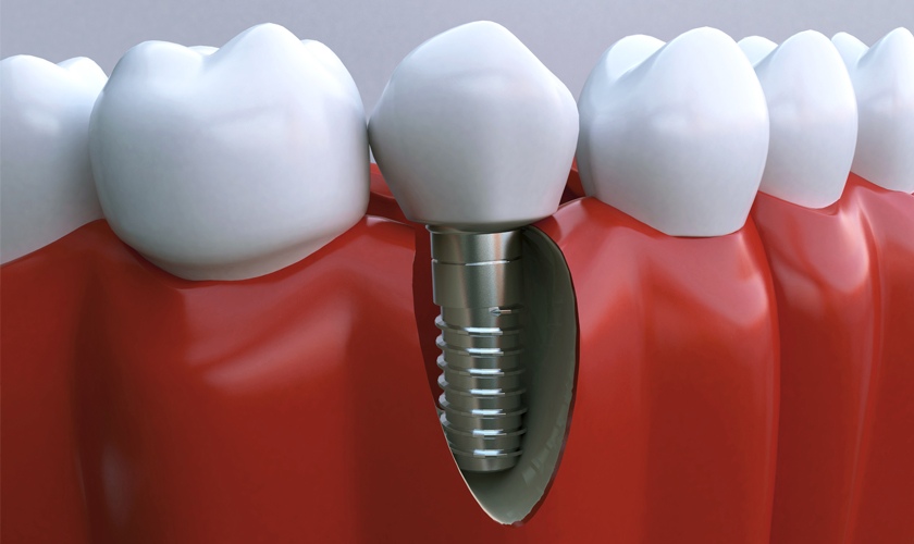 Cấy ghép răng Implant là gì?