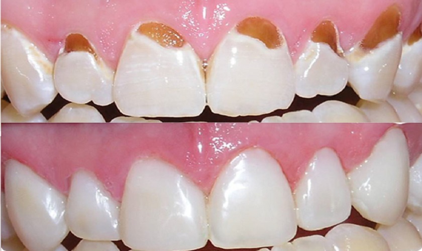 Trám răng khắc phục mòn cổ chân răng